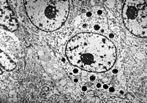 F,72y. | melanoblastoma oculi